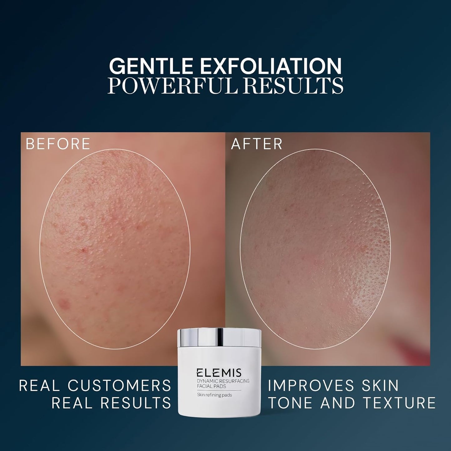 ELEMIS Dynamic Resurfacing Facial Pads, Gentle Textured Treatment Facial Exfoliating Pads