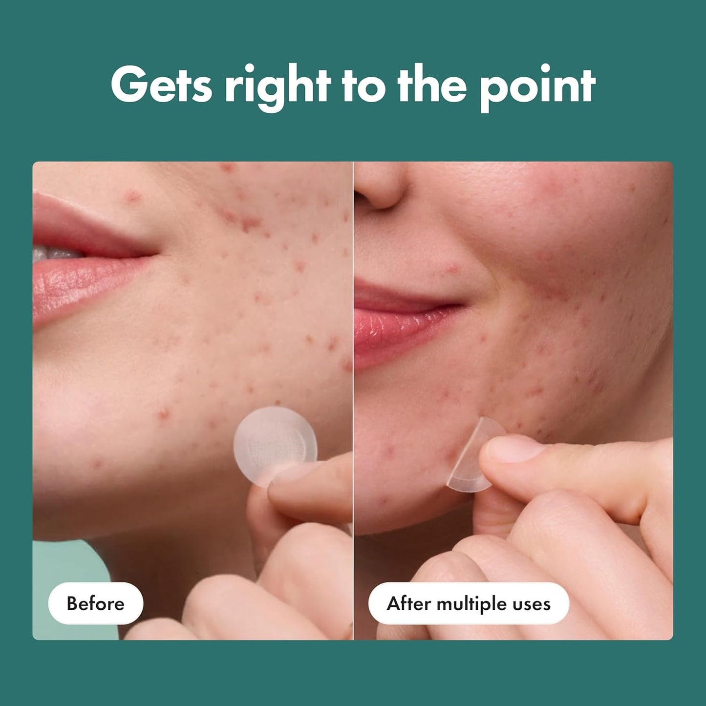 Mighty Patch Micropoint Large Hydrocolloid Pimple Patches for Face Blemishes from Hero Cosmetics, Acne Stickers for Early Stage Zits & Hidden Pimples, 395 Proprietary Micropoints, 8 Count