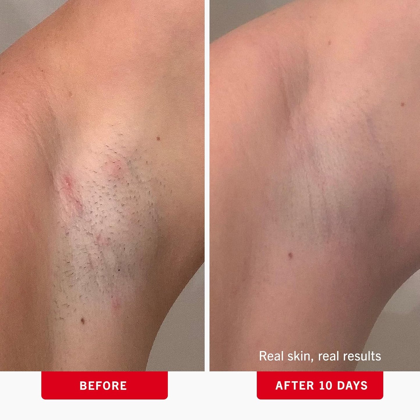 First Aid Beauty - Ingrown Hair Pads with BHA + AHA - Aftershave Treatment Pads to Help Prevent Razor Bumps for Men & Women - Exfoliate Underarms & Bikini Area - Compostable for Daily Use - 60 Pads
