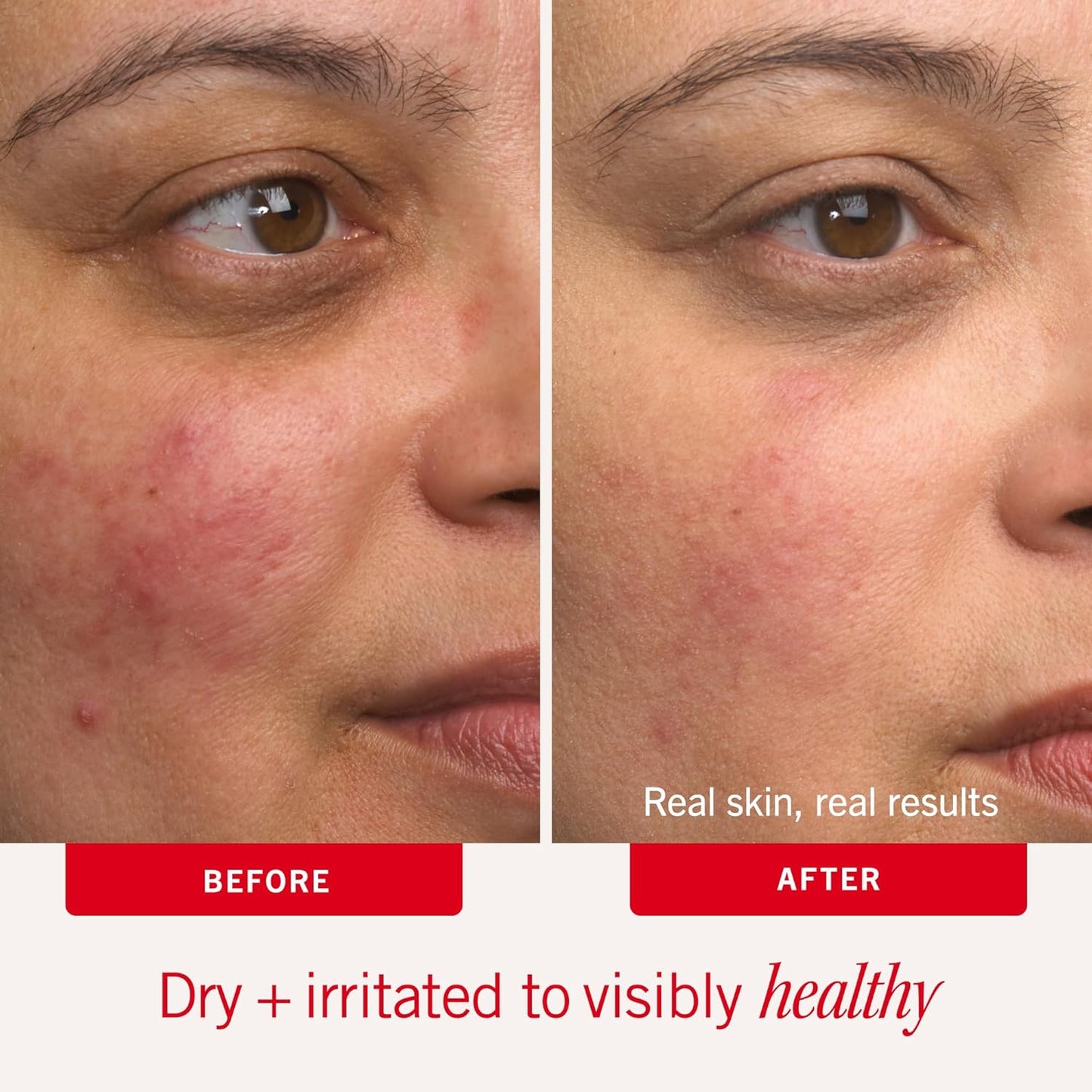 First Aid Beauty - Ultra Repair Cream - Intense Hydration Face & Body Moisturizer - Whipped Colloidal Oatmeal Clinically Proven to Strengthen Skin Barrier in 7 Days - Helps Relieve Eczema, 8 oz