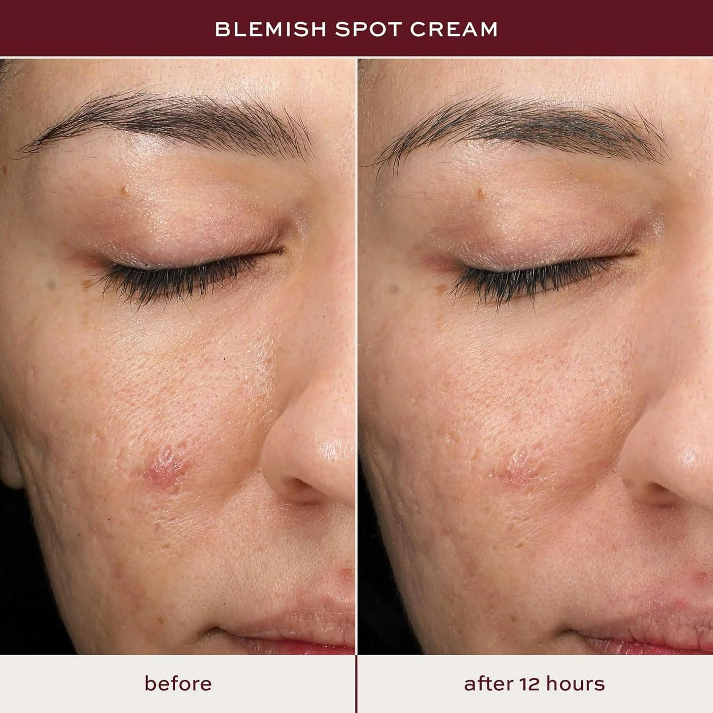 ITK Skincare Salicylic Acid Acne Spot Treatment for Face, Back & Body - Fast Active Acne Relief - Pimple Cream for Acne Prone Skin - Clear Blemishes Fast with Tea Tree Oil - 0.5oz