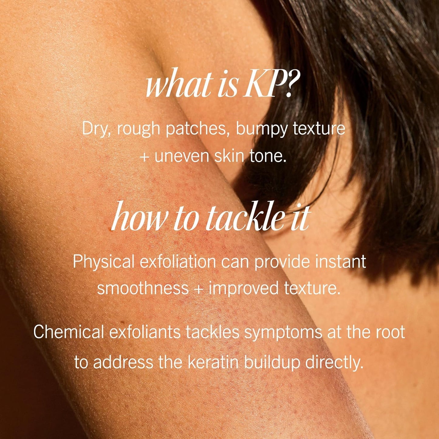First Aid Beauty - KP Bump Eraser Body Scrub with 10% AHA, Keratosis Pilaris Skin Exfoliater with Glycolic and Lactic acids, Helps Reduce Chicken Skin Bumps, Safe for Sensitive Skin, 8 oz + Bonus, 2ct